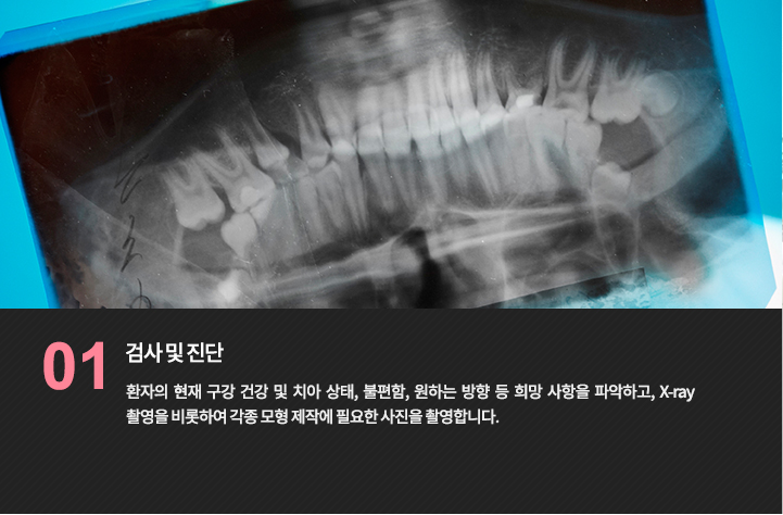 -검사 및 진단
환자의 현재 구강 건강 및 치아 상태, 불편함, 원하는 방향 등 희망 사항을 파악하고, X-ray 촬영을 비롯하여 각종 모형 제작에 필요한 사진을 촬영합니다.
