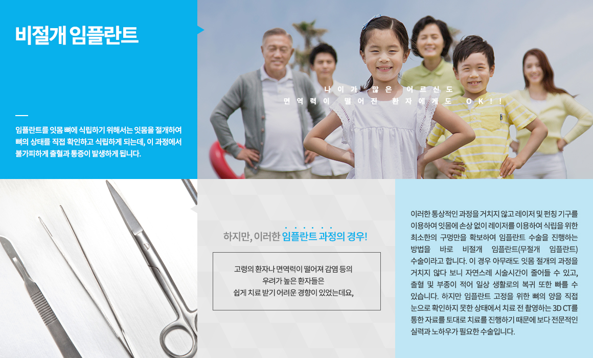 평균적인 성인의 치아개수는 약 28~32개로 치아가 필요한 제 기능을 다하기 위해서는 결손 된 치아 없이 모든 치아가 제 자리에 있어야 합니다. 하지만 예기치 못한 사고나 심한 치주질환 등으로 치아를 상실하게 되는 경우도 있는데, 이때 이를 방치하게 되면 빠진 치아의 자리에 치아와 맞물리는 치아가 아래로 내려오거나 도미노처럼 주변의 치아들이 빈 치아 공간으로 쓰러지는 현상이 나타나 전반적으로 치아의 간격이 넓어질 수 있어 치아의 탈락이 이루어진 자리에는 새로운 대체 치아를 식립하는 것이 바람직합니다. 
씹는 즐거움 선물!! 치주질환이나 사고 등으로 인해 상실된 자아의 자리에 인체에 무해하면서도 부작용이 없는 티타늄으로 제작된 본체를 심고, 그 위에 내 자연 치와 유사한 보철물을 씌워 본래의 내 치아와 같은 기능을 회복시켜 주는 치료입니다. 자연치아는 최대한 살리고, 꼭 필요한 만큼의 최소 임플란트 식립 원칙!